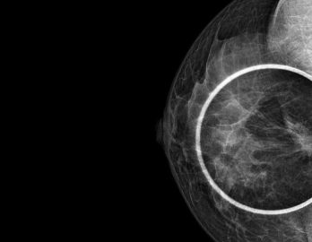 mamografias